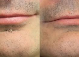 toccera® Microneedle Clear Patches ✨Targets Skin Tags, Acne, Wrinkles & Blemishes