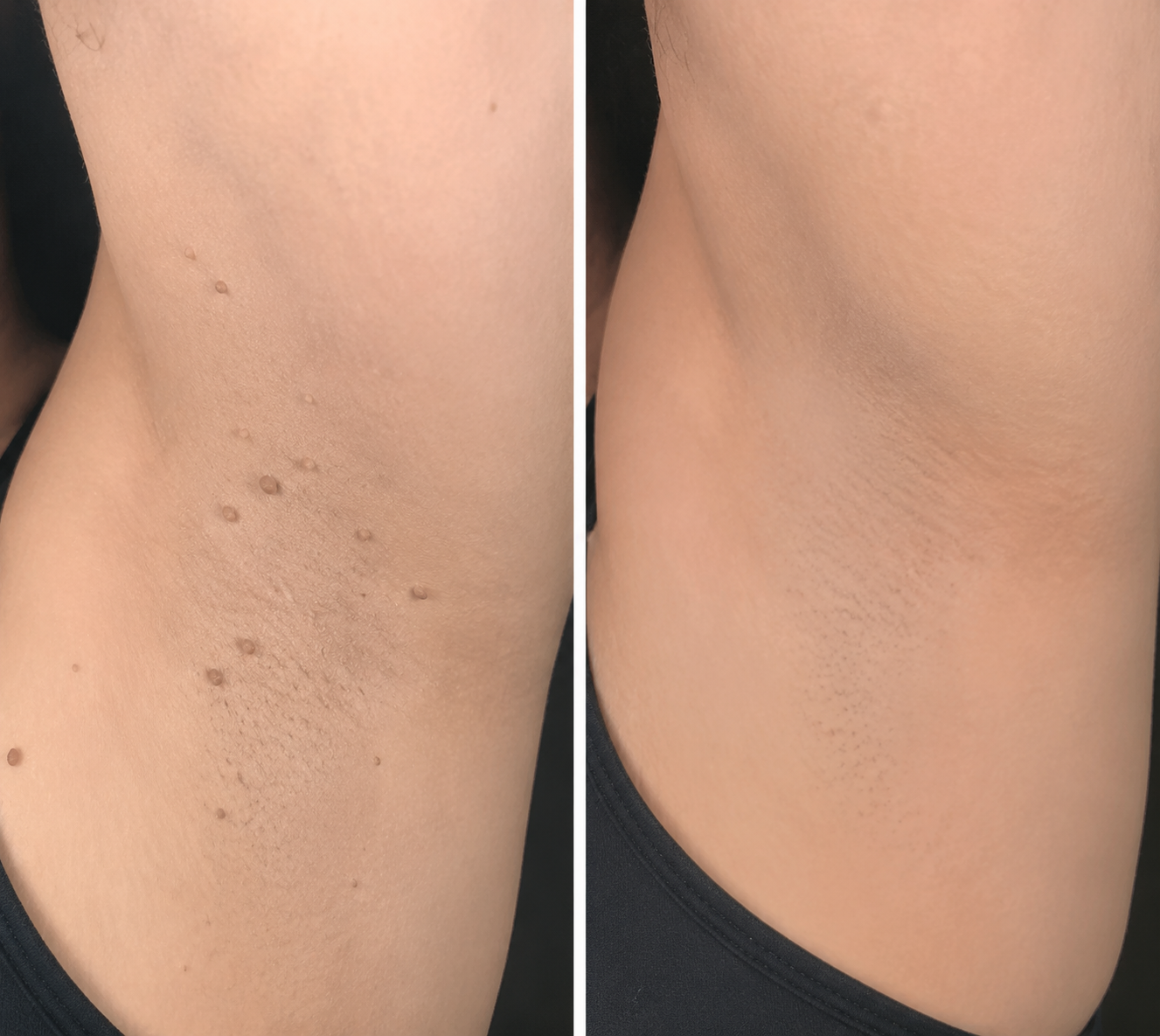 toccera® Microneedle Clear Patches ✨Targets Skin Tags, Acne, Wrinkles & Blemishes