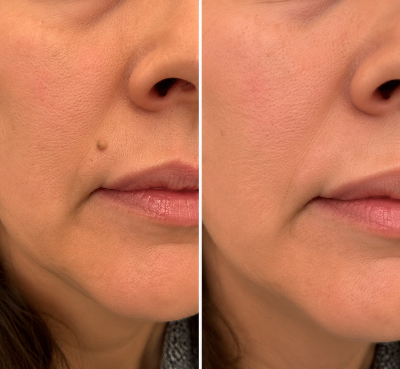 toccera® Microneedle Clear Patches ✨Targets Skin Tags, Acne, Wrinkles & Blemishes
