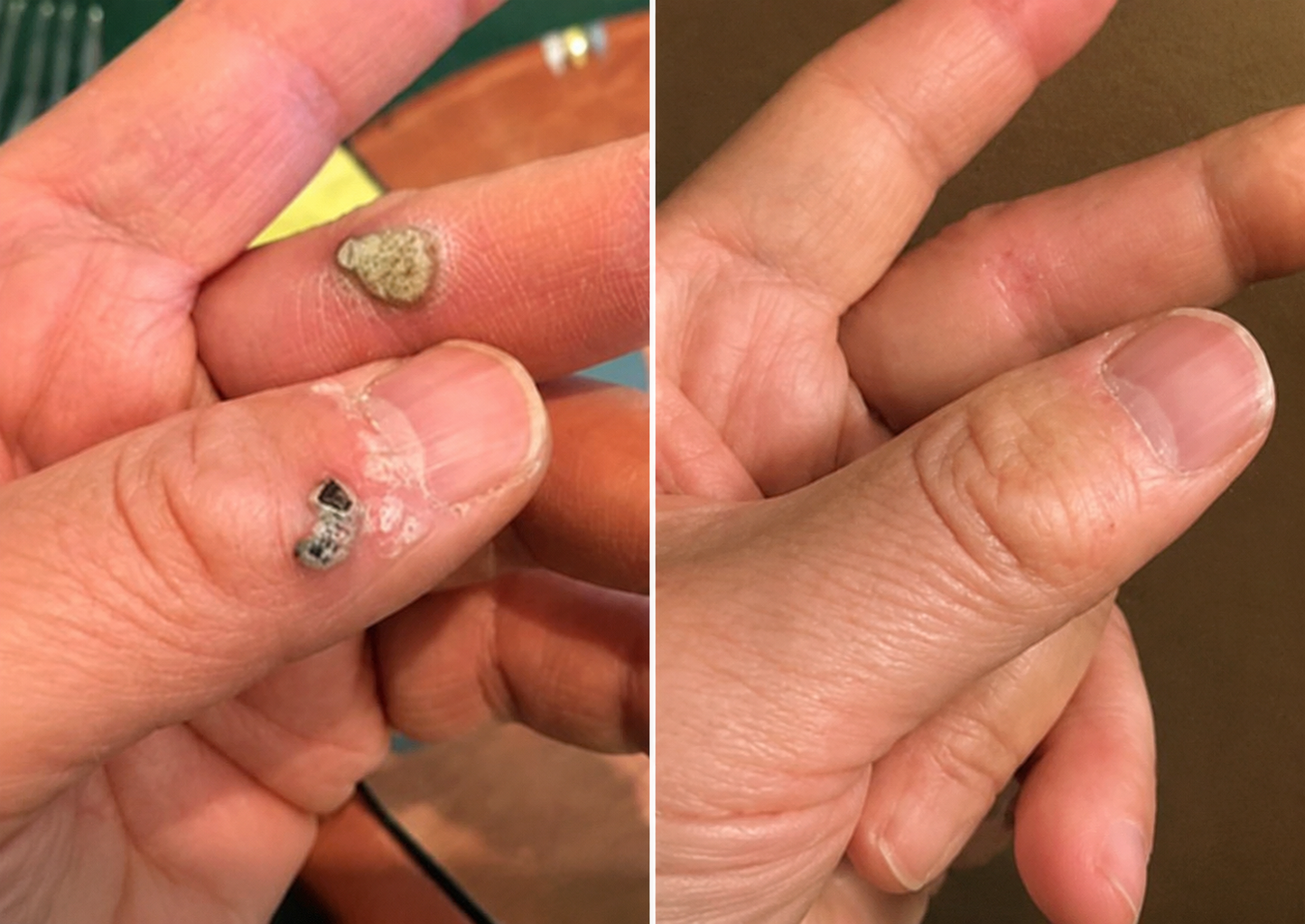 toccera® Microneedle Clear Patches ✨Targets Skin Tags, Acne, Wrinkles & Blemishes
